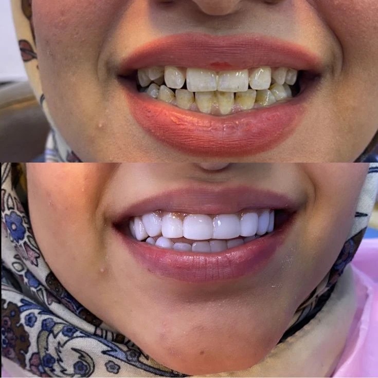 نمونه کار دندانپزشکی دکتر امینی اهواز